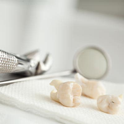 Tooth Extraction